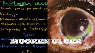 Mooren’s Ulcer  Peripheral Corneal Ulcer [upl. by Natalee]