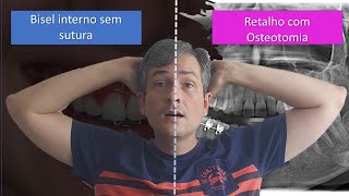 GengivectomiaGengivoplastia errada nunca mais [upl. by Jecho798]