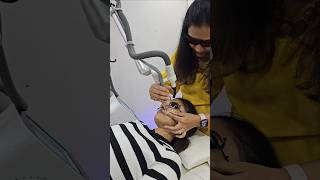 Laser Treatment for Acne Scars  acne shorts [upl. by Leonhard]