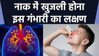 नाक में खुजली होना Allergic Rhinitis Symptoms क्या है उपाय  Boldsky [upl. by Eidod]