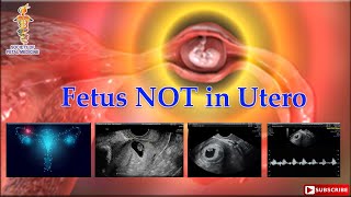 Fetus NOT in Utero [upl. by Engud165]