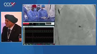 Live Case 1  Impella Supported PCI of Calcified LAD using Rotational Atherectomy and OCT Guidance [upl. by Aseefan819]