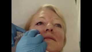 Injecting Platelet Rich Plasma around the eye [upl. by Nwahsav466]