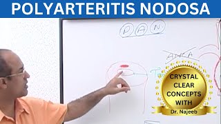 Polyarteritis Nodosa Clinical Features  Complications  Management [upl. by Naivad]