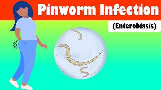 Pinworm Infection Enterobiasis  Causes Signs amp Symptoms Treatment [upl. by Gad]