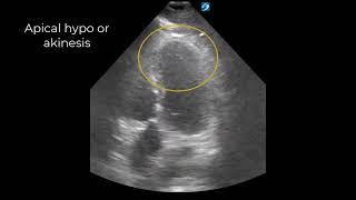 Chest Pain and Automated ECG Read of Nonspecific STwave Abnormalities [upl. by Aynos774]