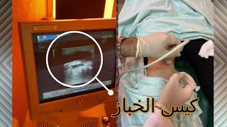 Baker cyst aspiration ultrasound guided علاج كيس الخبازبالسونار [upl. by Ettenawtna]