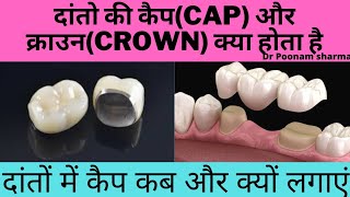 दांतों की कैपcapऔर क्राउनcrown क्या होता हैdental cap कब और क्यों लगाएं tooth capping and crown [upl. by Brotherson]