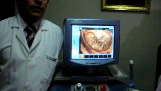 INFERTILIDAD Y REPRODUCCION ASISTIDA  DR FERNANDO GARCIA ARMAS  PERU [upl. by Vona358]