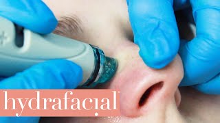 What is Hydrafacial Treatment  The Red Carpet Facial [upl. by Esinaj]