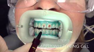 Professional InOffice Teeth Whitening by Mint Dental OC in Yorba Linda Orange County [upl. by Alviani]