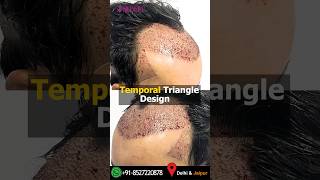 Incredible 3000 Advanced FUE Grafts Hair Transplant at Medispa Clinic By Dr Suneet Soni [upl. by Ocicnarf227]