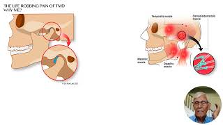 Suicidal thoughts due to TMJTMD [upl. by Moira]