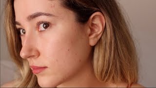 One Year Off Accutane My Acne Is Back An Emotional Update [upl. by Enyleve]