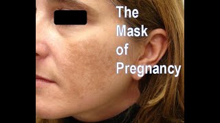 Melasma The Mask of Pregnancy Lichen Simplex Chronicus and What the Heck Is Eczema [upl. by Alcott638]