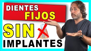 ¿𝗗𝗜𝗘𝗡𝗧𝗘𝗦 𝗙𝗜𝗝𝗢𝗦 𝗦𝗜𝗡 𝗜𝗠𝗣𝗟𝗔𝗡𝗧𝗘𝗦 dentales👍 Lo ÚLTIMO en PUENTES DENTALES Fijos de Zirconio [upl. by Ainslie]