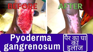 Pyoderma gangrenosum  large leg ulcer treatment  पैर का घा का इलाजDr Uttam Kumar Lenka [upl. by Anaes]