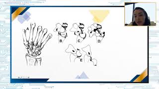 Uso de injertos en reconstrucción de ligamento cruzado anterior [upl. by Tiossem836]