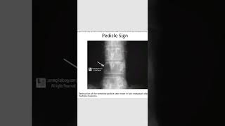 Pedicle sign lytic diseaseradiology orthopedics [upl. by Neerol]