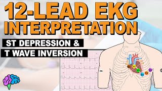 Myocardial Ischemia  ST Depression amp T Wave Inversion  12lead EKG [upl. by Osnofla]