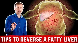 4 Critical Tips to Reverse a Fatty Liver – Dr Berg [upl. by Nuawed]