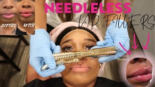 GETTING MY LIPS DONE🖊️👄Hyaluron Pen Lip Fillers Very Detailed Painless [upl. by Adnoryt841]