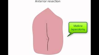 Basics of colorectal operations [upl. by Monroe]