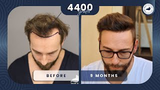 Witness the Incredible Results of a 4400 Graft Hair Transplant in Just 9 Months [upl. by Schnorr6]