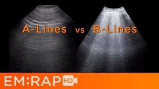 Ultrasound of Pulmonary Edema [upl. by Ladnyc334]