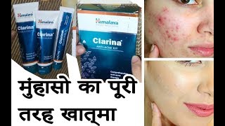 Himalaya Clarina ANTI ACNE KIT Review  Hindi  हिंदी [upl. by Orly63]