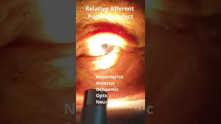 RAPD Relative Afferent Pupillary Defect [upl. by Anayt]