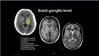 Basal ganglion anatomy [upl. by Toinette]