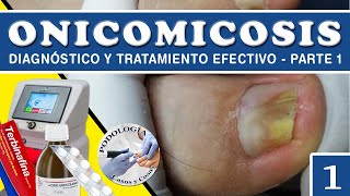 PARTE 1  ONICOMICOSIS  Diagnóstico y Tratamiento Efectivo  Podología Casos y Cosas [upl. by Taber]