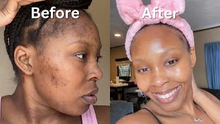 How I Cleared My Acne  Dark Spots  Hyperpigmentation for good in 1 month NO ACCUTANE VIDEO PROOF [upl. by Roselba]