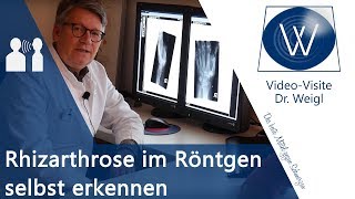 Fingerarthrose amp Daumenarthrose im Röntgen selber erkennen🤓 Diagnostik amp Radiologie Rhizarthrose [upl. by Tenaj230]