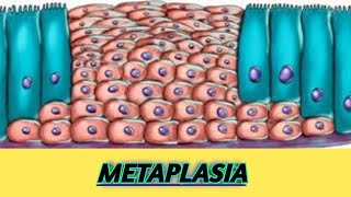 Metaplasia mechanism and examples  Dysplasia aplasia hypoplasia [upl. by Wadlinger]