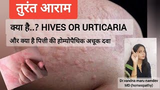 पित्ती उछलना  Hives or urticaria की होम्योपैथिक अचूक medicine [upl. by Mylor]