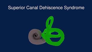 Superior Canal Dehiscence Syndrome SCDS [upl. by Asecnarf]