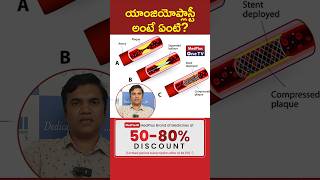 Understanding Angioplasty and Stenting Quick Guide l Dr A Ravikanth shorts MedPlusONETV [upl. by Berriman]