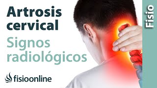 Artrosis cervical  Signos radiológicos [upl. by Robinette]