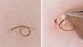 Compilation Of Ingrown Hairs In Girls Leg [upl. by Einaffets]