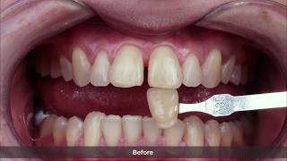 ENG Whitening and diastema closure with Whiteness HP AutoMixx and Vittra APS [upl. by Airrat973]