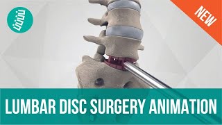 Lumbar Disc Replacement with 3rdGen Technology [upl. by Gerek]