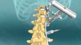 Scoliosis Spinal Fusion Animation [upl. by Paget]