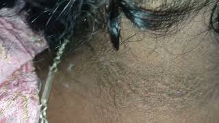 what are disease associated with acanthosis nigricans [upl. by Trahern]