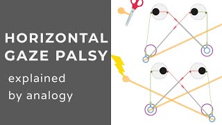 Horizontal Gaze Palsy  Strokes amp Seizures  Animation  Explained Conceptually [upl. by Marks]