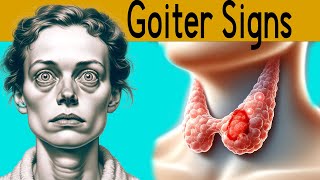 Goiter explained under 3 minutes Causes Symptoms Treatment [upl. by Assirral183]