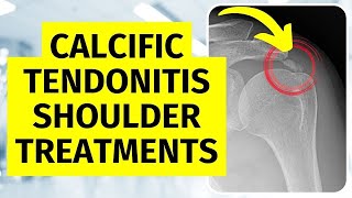 Calcific Tendonitis Shoulder Treatments Without Surgery [upl. by Ocirne]