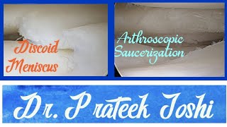 Arthroscopic Saucerization Partial Meniscectomy  Discoid Lateral Meniscus  Dr Prateek Joshi [upl. by Yrallam369]