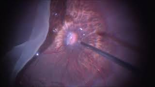 Vitrectomy for Giant retinal tear  Myopia  GRT  Retinal Detachment  Dr Manish Nagpal [upl. by Mariejeanne]